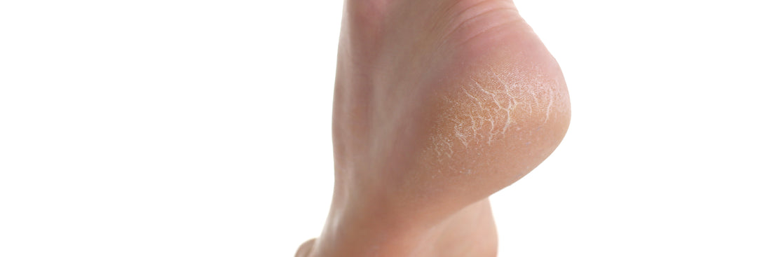 HOW TO GET RID OF CRACKED HEELS